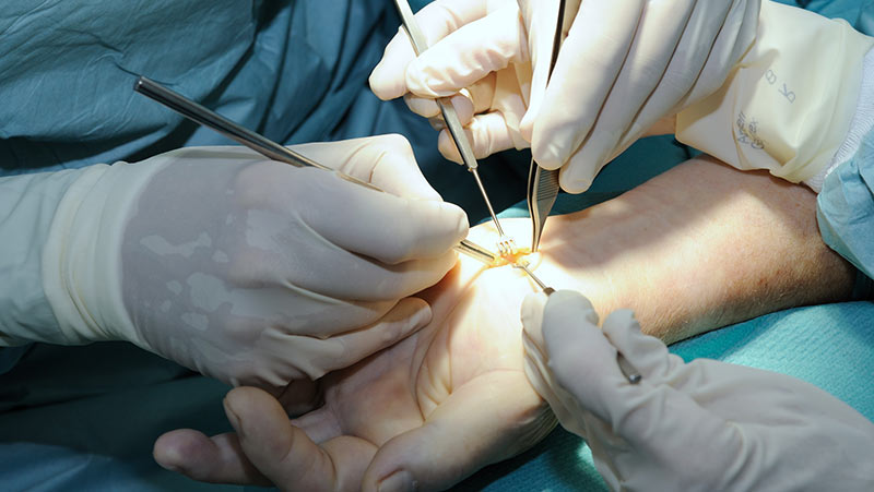 Handchirurgie Karpaltunnel Syndrom